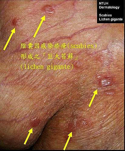 男性外生殖器:皮肤病灶之诊断